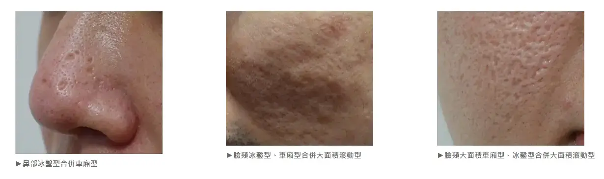 凹陷性痘疤 — 異體真皮移植
