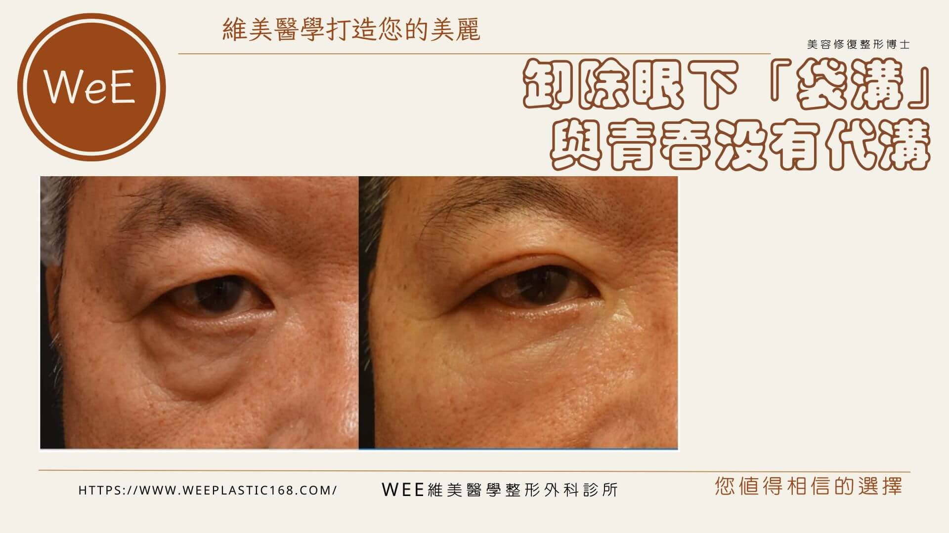結合手術與填充改善眼袋淚溝