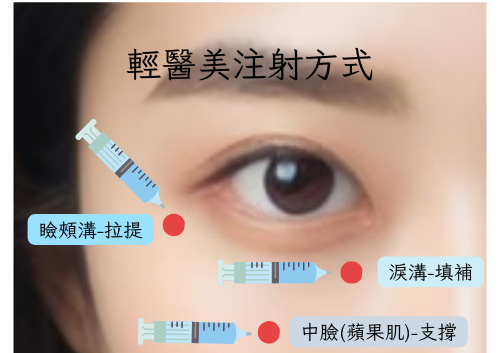 輕醫美注射方式