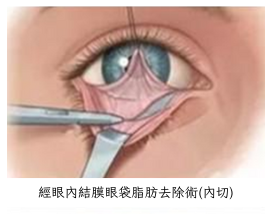 內切外切手術比較 1