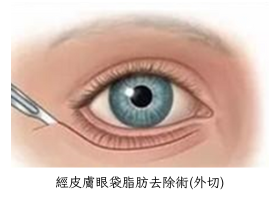 內切外切手術比較 2