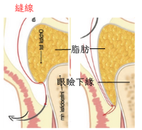 脂肪移位手術