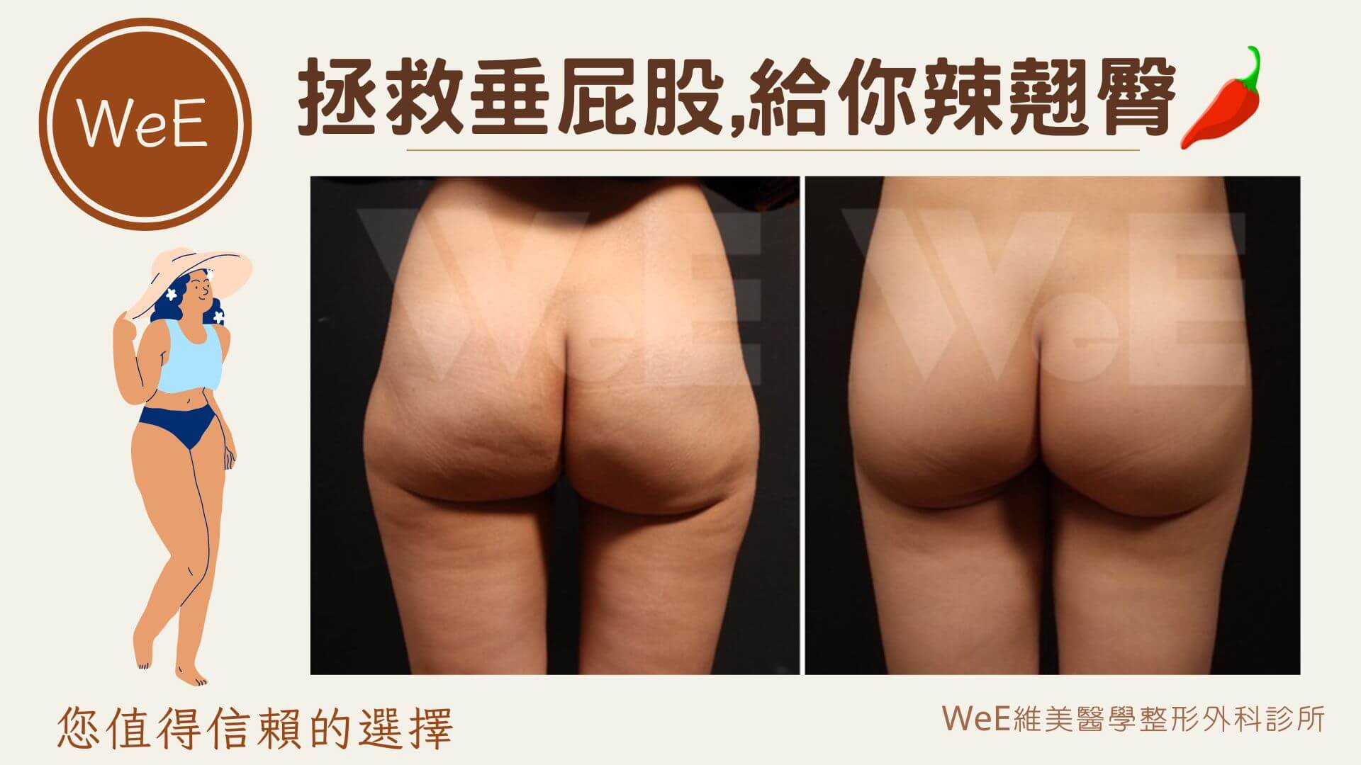 巴西提臀 BBL