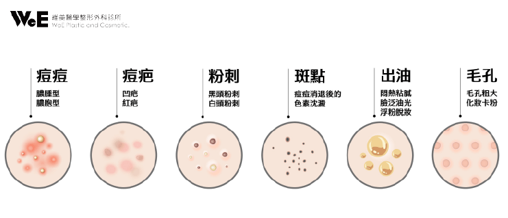 CAPRI 藍雷射 — 皮脂腺問題造成的常見肌膚困擾