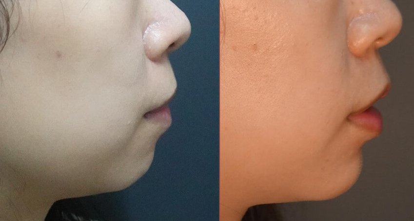 下巴 V 臉 WEE 成功案例 3