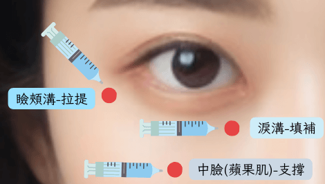 輕醫美注射方式說明