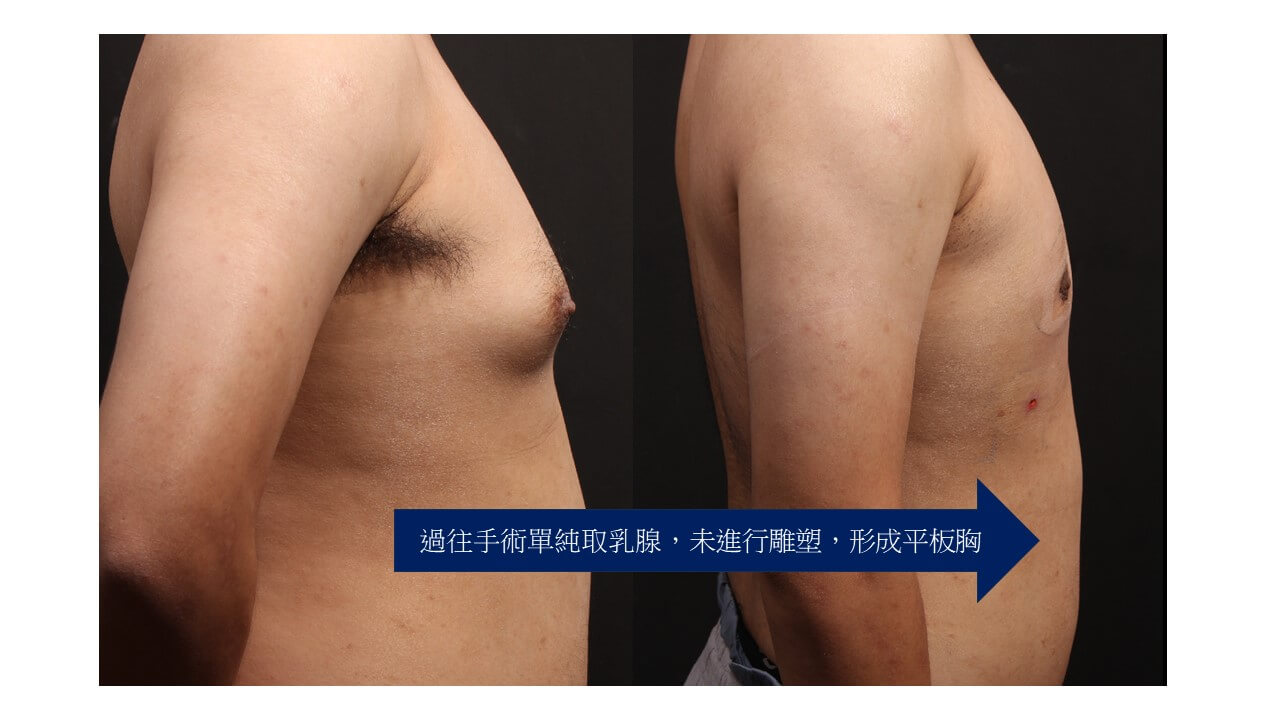 過往男性女乳症傳統治療對比