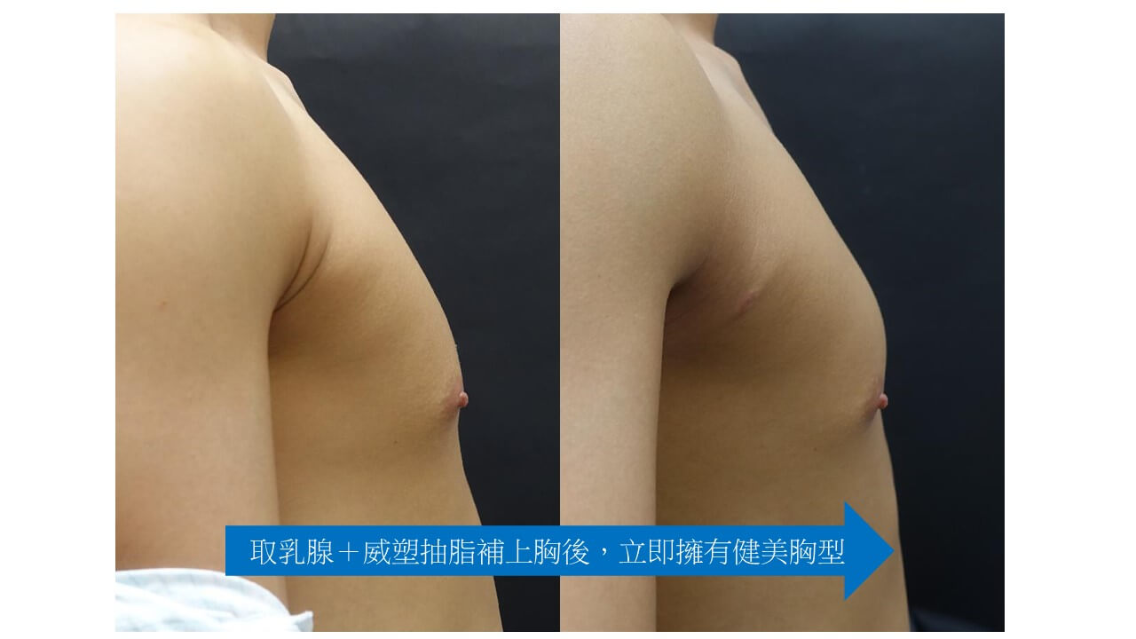 WeE 威塑男性女乳治療成功案例 1