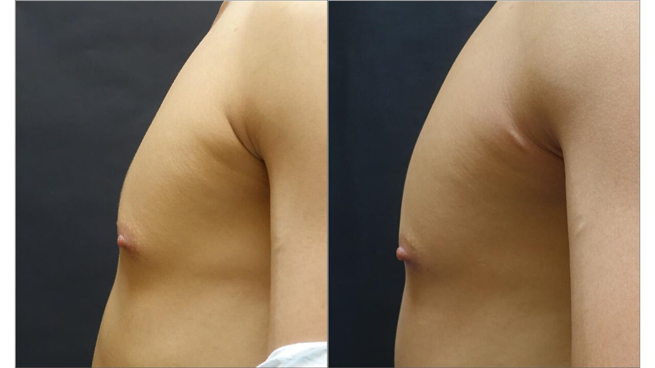 WeE 威塑男性女乳治療成功案例 3
