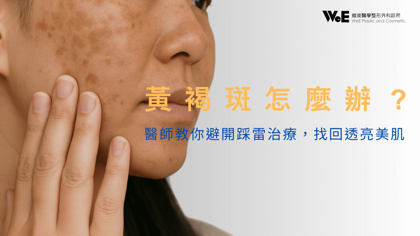 黃褐斑(肝斑)完整治療指南