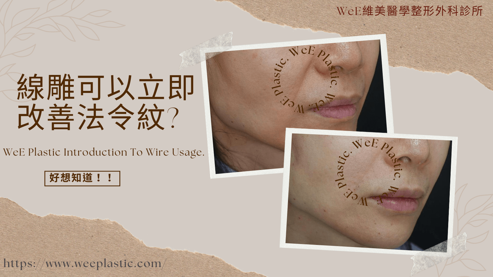 法令紋材料 — Voluma 與 PLLA
