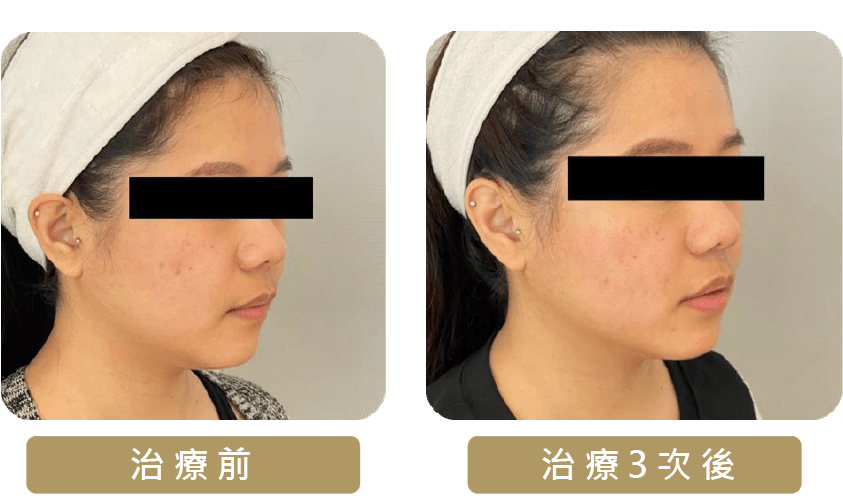 ONDA PRO 超微波案例 1 — 輪廓線修飾