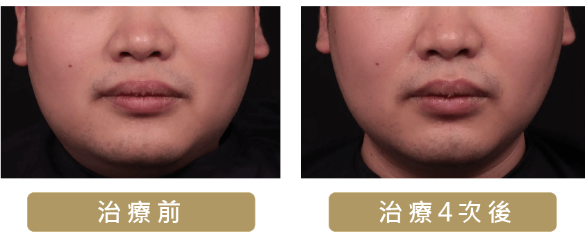 ONDA PRO 超微波案例 2 — 臉部雕塑