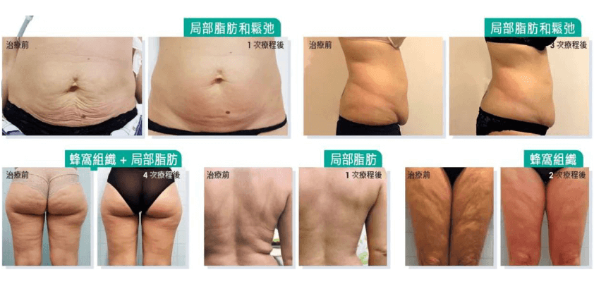 ONDA PRO 超微波案例 3 — 身體療程