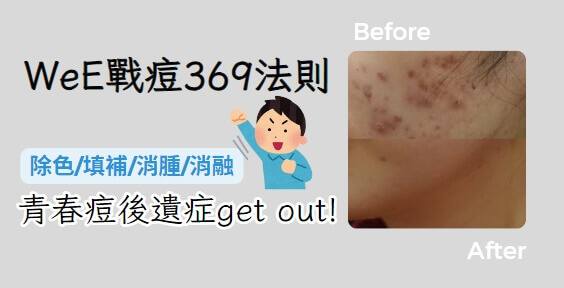 青春痘戰痘機 — 維醫青春痘治療設備總覽