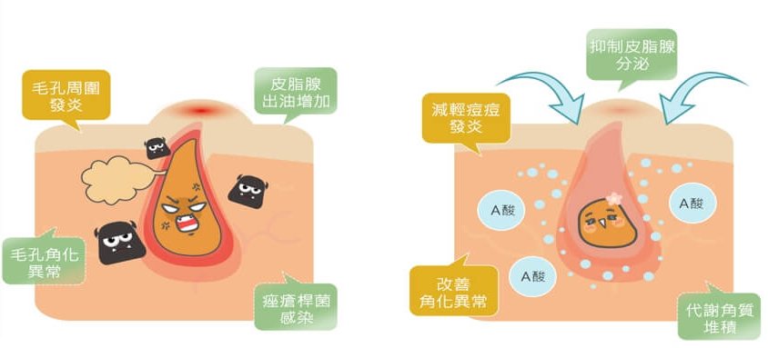 A 酸治療痘痘示意圖