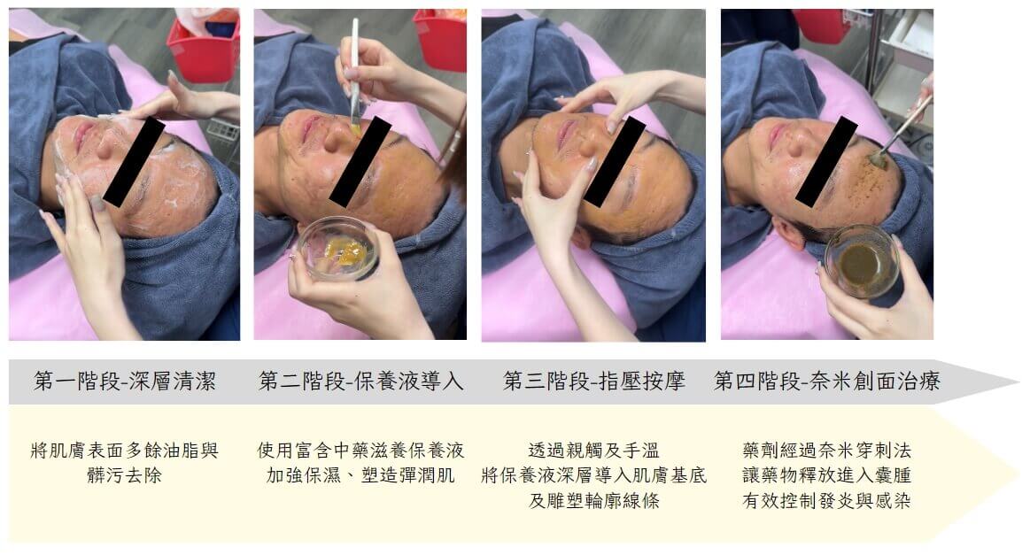 奈米創面治療青春痘流程