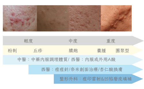 青春痘四種類型紅黑凹凸對照圖