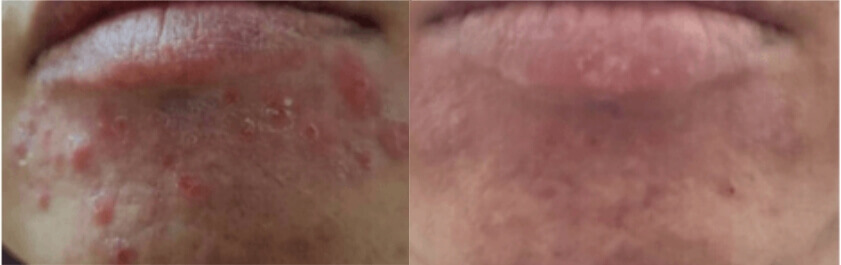 下巴囊腫型青春痘治療案例