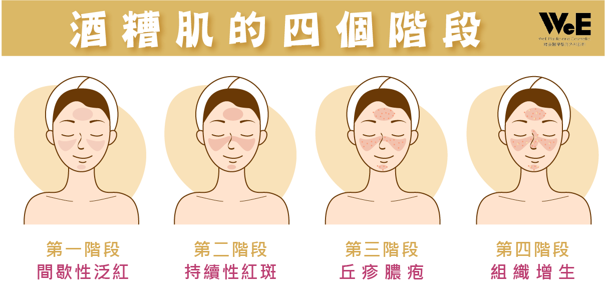 酒糟性肌膚四個階段對照圖