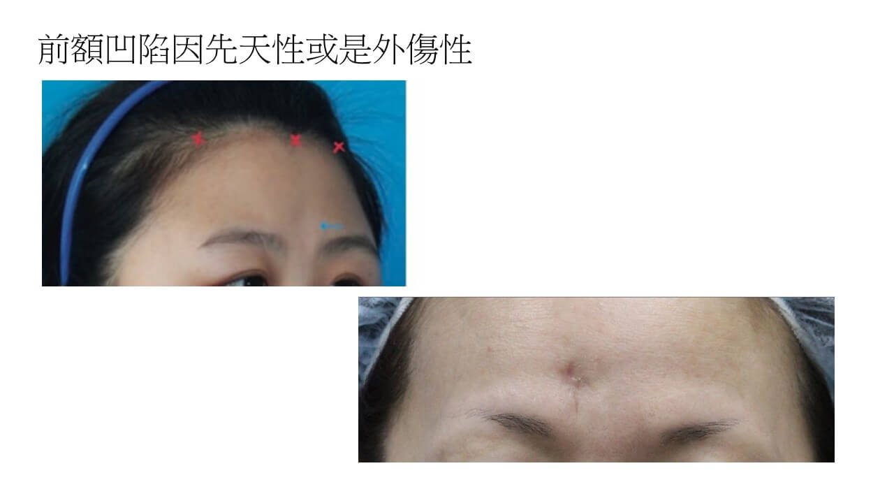 前額凹陷或外傷案例