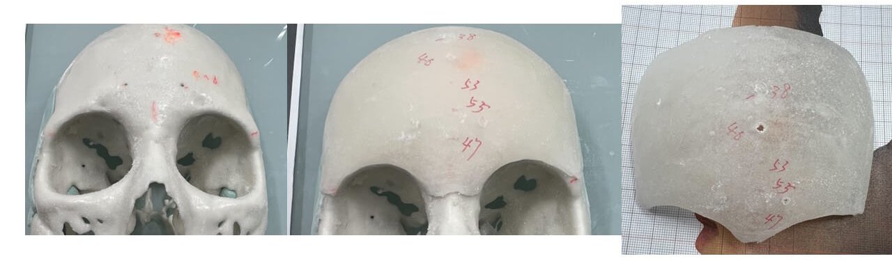 前額假體客製化 3D 列印