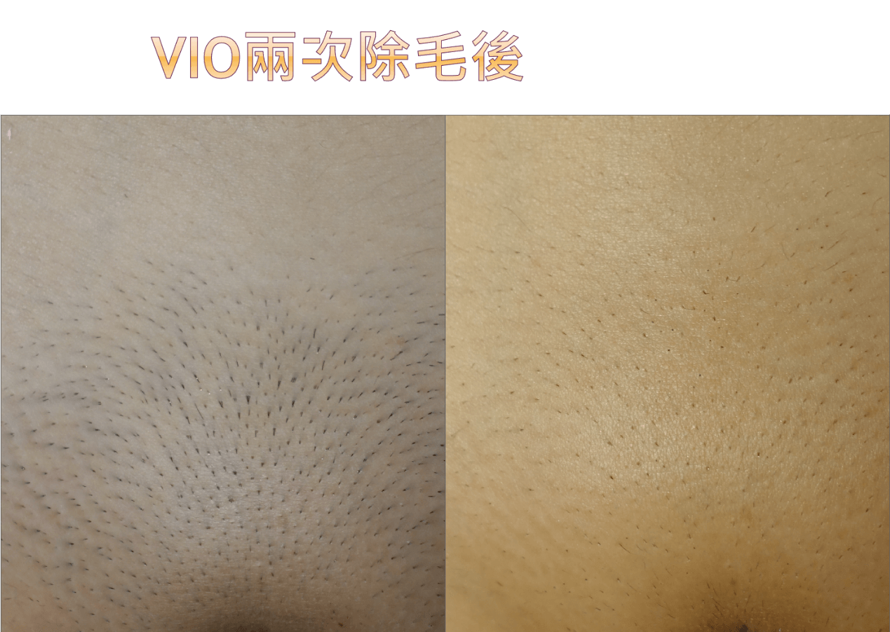 WeE 雙波私密處 VIO 除毛雙波長機台說明
