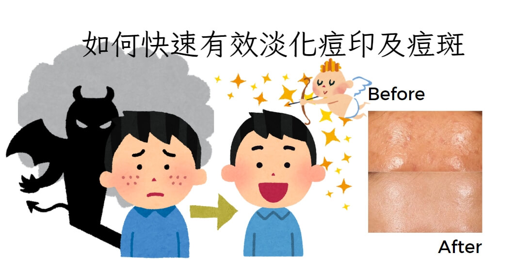 痘斑痘印如何快速改善