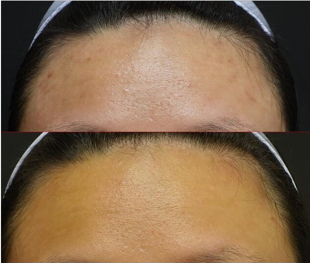 色素型痘痘 — 黑色痘印及痘斑案例